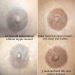 3D AREOLA BREAST RECONSTRUCTION AFTER BREAST CANCER